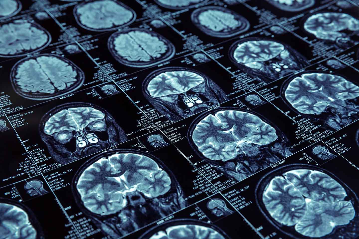 Personalized Brain model flexibility illustration