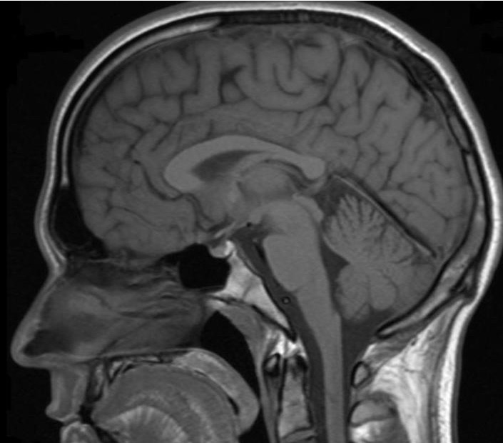 T1-weighted MR image mapping